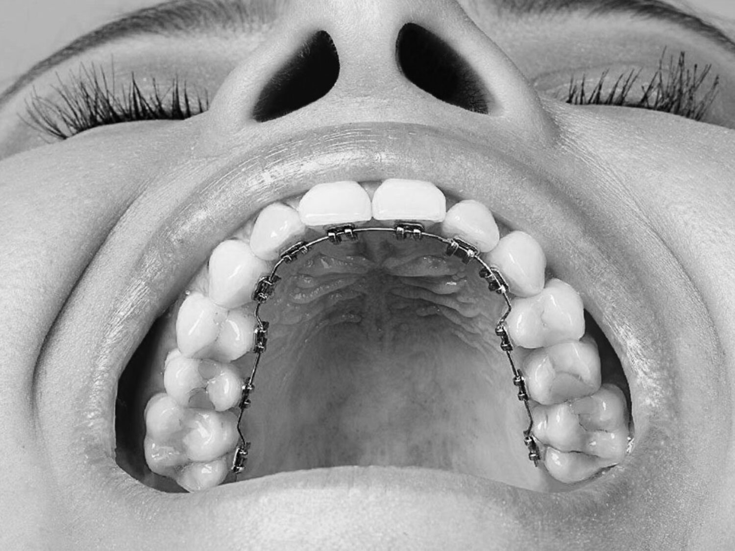 Invisalign is one of the most advanced dental treatments in Dubai to correct teeth misalignment.