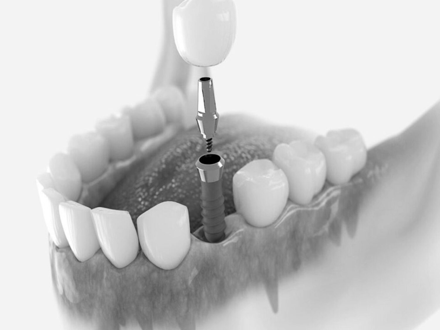 IMPLANTS AND ORAL SURGERIES